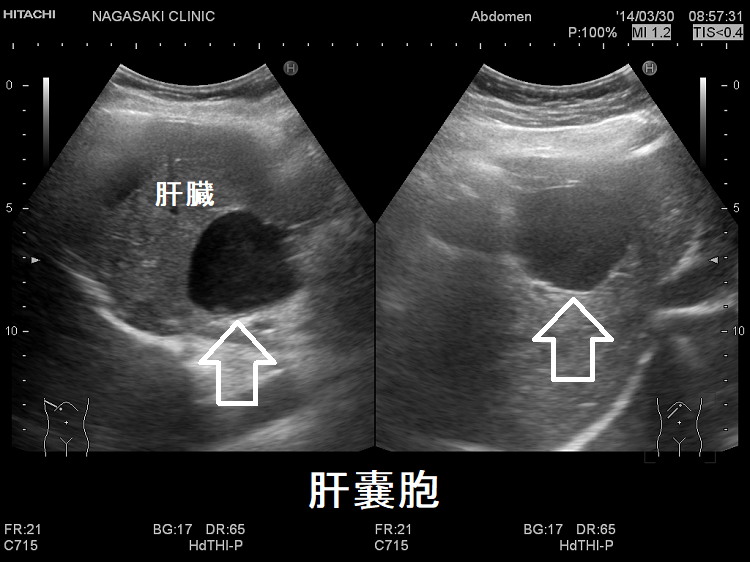 肝嚢胞 超音波エコー画像 肝嚢胞 超音波エコー画像