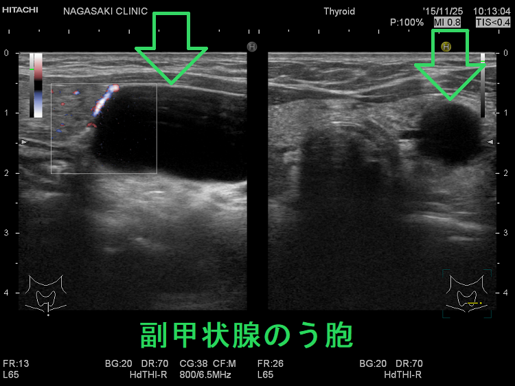 副甲状腺のう胞(超音波エコー画像) 副甲状腺のう胞