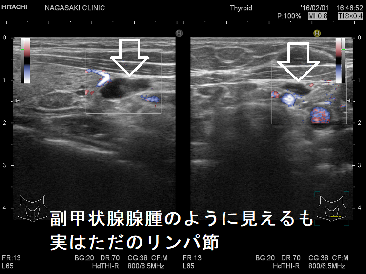 副甲状腺腺腫のように見えるも、実はただのリンパ節 超音波(エコー)画像 副甲状腺腺腫のように見えるも、実はただのリンパ節 超音波(エコー)画像