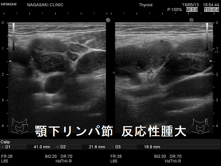 顎下リンパ節 反応性腫大 超音波(エコー)画像2 顎下リンパ節 反応性腫大 超音波(エコー)画像2