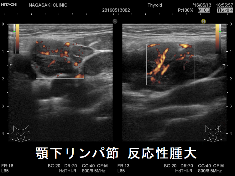顎下リンパ節 反応性腫大 超音波(エコー)画像 ドプラーモード2 顎下リンパ節 反応性腫大 超音波(エコー)画像 ドプラーモード2