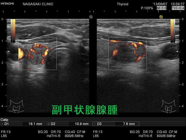 副甲状腺腺腫 超音波(エコー)画像 副甲状腺腺腫 超音波(エコー)画像