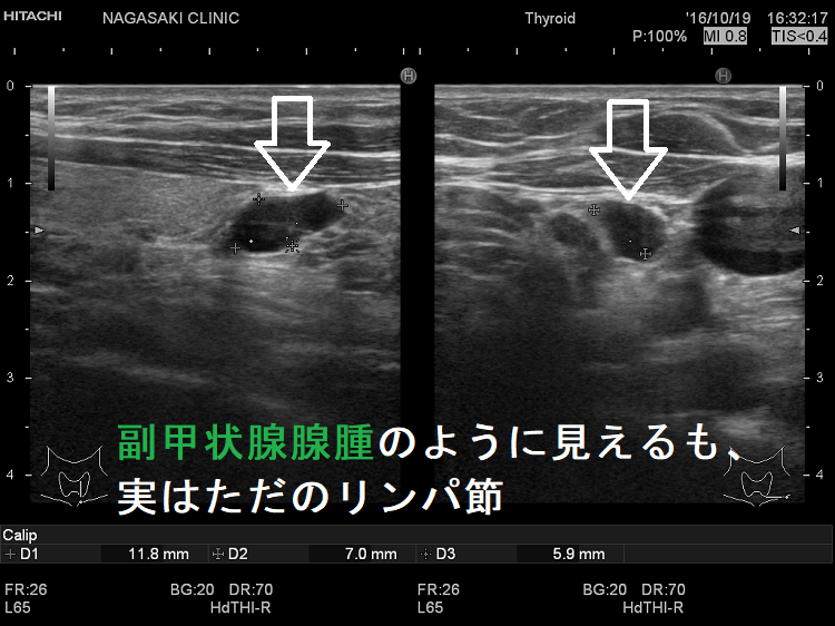 副甲状腺腺腫のように見えるがリンパ節 副甲状腺腺腫のように見えるがリンパ節