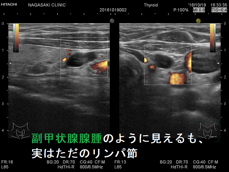 副甲状腺腺腫のように見えるがリンパ節 ドプラーモード 副甲状腺腺腫のように見えるがリンパ節 ドプラーモード