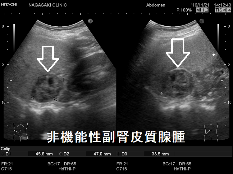 非機能性副腎皮質腺腫 超音波(エコー)画像2 非機能性副腎皮質腺腫 超音波(エコー)画像2