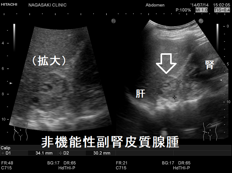 非機能性副腎皮質腺腫 超音波(エコー)画像 非機能性副腎皮質腺腫 超音波(エコー)画像3
