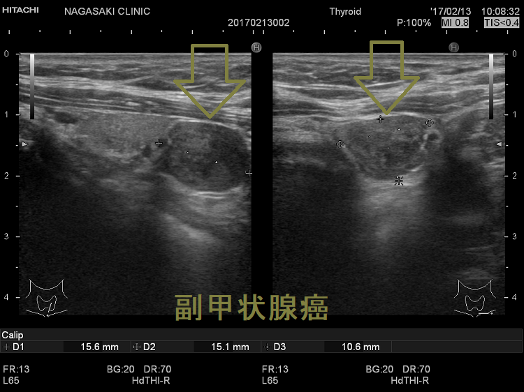 副甲状腺癌 超音波(エコー)画像 副甲状腺癌 超音波(エコー)画像