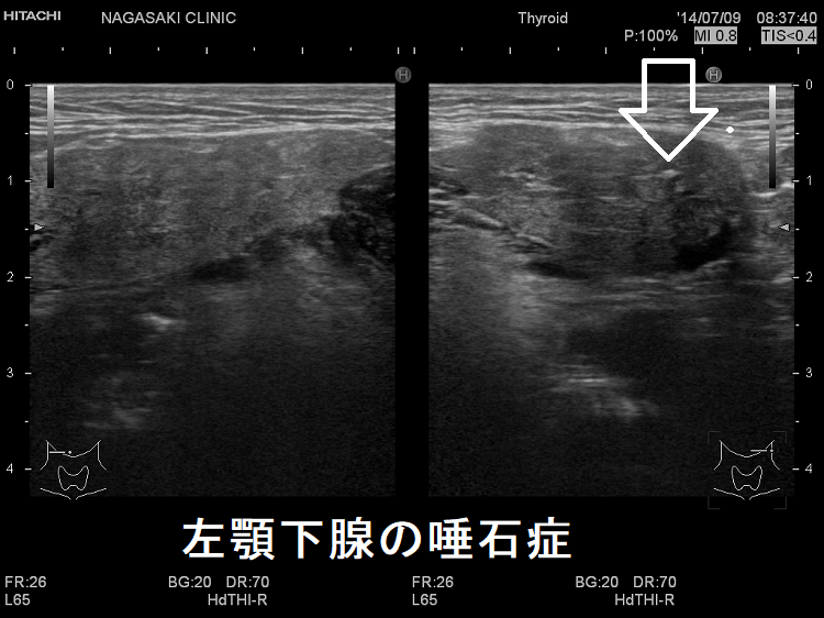 左顎下腺の唾石症 超音波(エコー)画像 左顎下腺の唾石症 超音波(エコー)画像