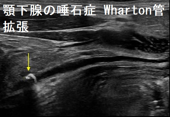 顎下腺の唾石症 Wharton管拡張 超音波(エコー)画像 顎下腺の唾石症 Wharton管拡張 超音波(エコー)画像