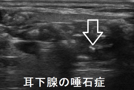 耳下腺の唾石症 超音波(エコー)画像 耳下腺の唾石症 超音波(エコー)画像