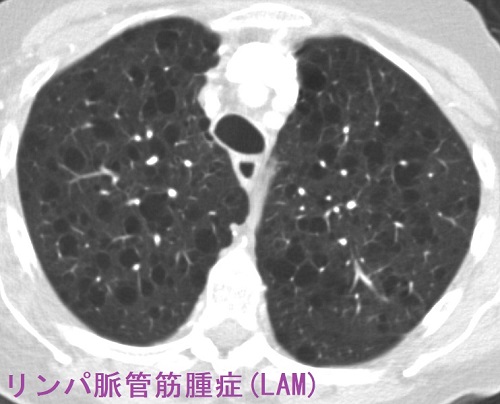 リンパ脈管筋腫症(LAM) リンパ脈管筋腫症(LAM)