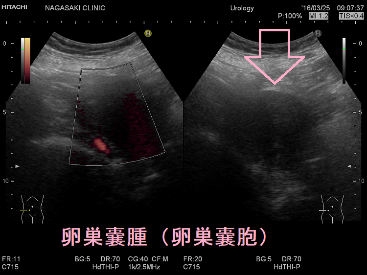 卵巣嚢腫(卵巣嚢胞) 超音波(エコー)画像 卵巣嚢腫(卵巣嚢胞) 超音波(エコー)画像