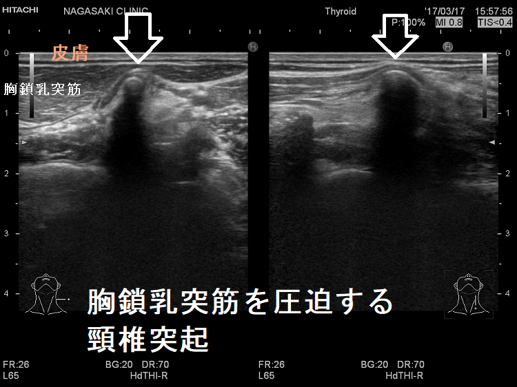 皮膚直下に頸椎突起 胸鎖乳突筋を圧迫 超音波(エコー)画像 皮膚直下に頸椎突起 胸鎖乳突筋を圧迫 超音波(エコー)画像