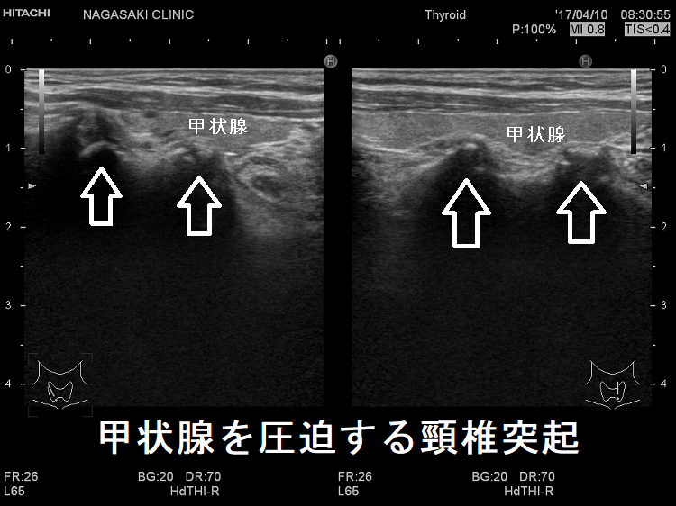 甲状腺を圧迫する頸椎突起 超音波(エコー)画像 甲状腺を圧迫する頸椎突起 超音波(エコー)画像