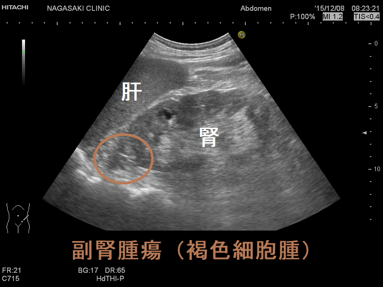 副腎腫瘍(褐色細胞腫)超音波(エコー)画像 副腎腫瘍(褐色細胞腫)超音波(エコー)画像