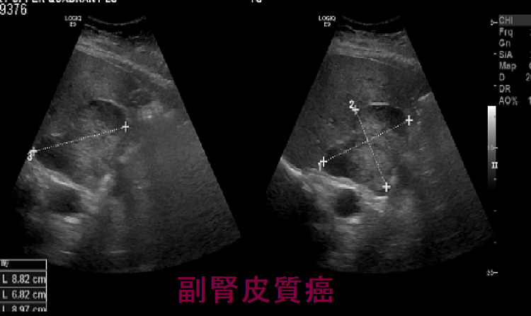 副腎皮質癌 超音波(エコー)画像 副腎皮質癌 超音波(エコー)画像
