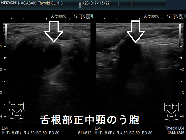 舌根部正中頸のう胞 舌根部正中頸のう胞