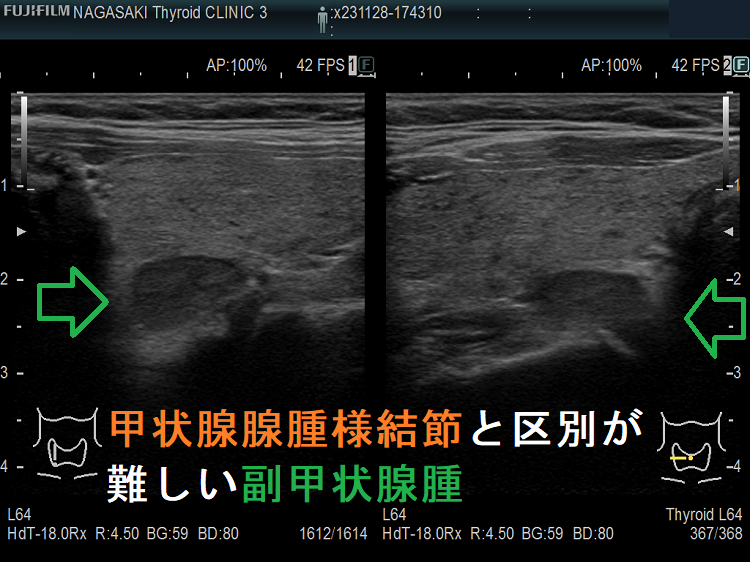 甲状腺腺腫様結節と鑑別が難しい副甲状腺腫 甲状腺腺腫様結節と鑑別が難しい副甲状腺腫