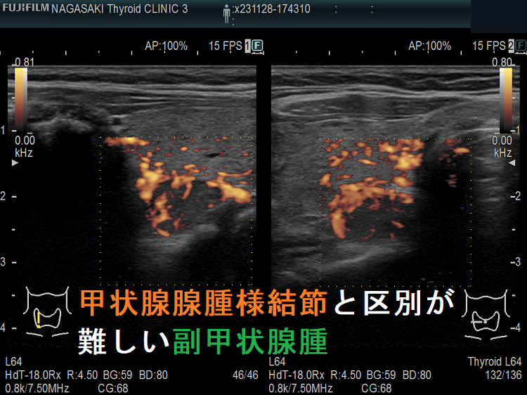 甲状腺腺腫様結節と鑑別が難しい副甲状腺腫 ドプラーモード 甲状腺腺腫様結節と鑑別が難しい副甲状腺腫 ドプラーモード