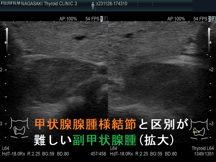 甲状腺腺腫様結節と鑑別が難しい副甲状腺腫(拡大) 甲状腺腺腫様結節と鑑別が難しい副甲状腺腫(拡大)
