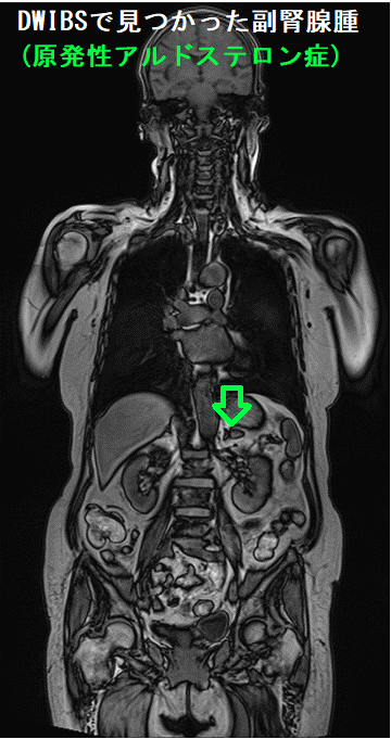 DWIBSで見つかった副腎腺腫(原発性アルドステロン症) DWIBSで見つかった副腎腺腫(原発性アルドステロン症)