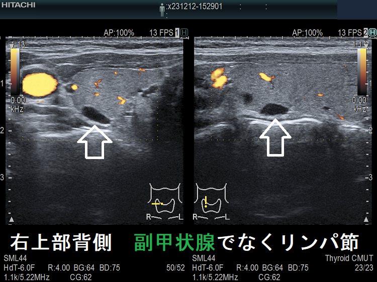 右上部背側 副甲状腺でなくリンパ節 右上部背側 副甲状腺でなくリンパ節