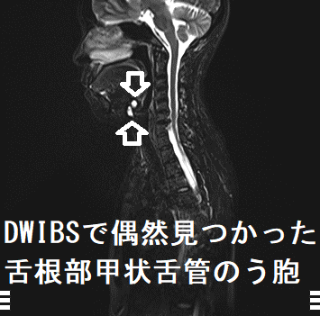 DWIBSで偶然見つかった舌根部甲状舌管のう胞 DWIBSで偶然見つかった舌根部甲状舌管のう胞