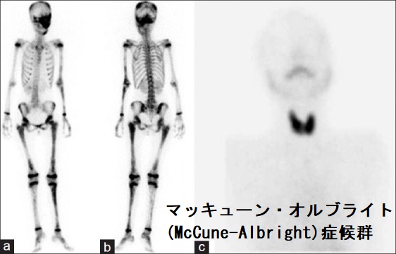 マッキューン・オルブライト(McCune-Albright)症候群 Tc99m-MDP全身骨スキャン Tc99m過テクネシウム甲状腺スキャン マッキューン・オルブライト(McCune-Albright)症候群 Tc99m-MDP全身骨スキャン Tc99m過テクネシウム甲状腺スキャン
