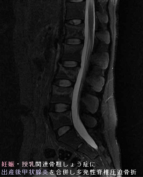 妊娠・授乳関連骨粗しょう症に出産後甲状腺炎を合併し多発性脊椎圧迫骨折 MRI T2強調画像 妊娠・授乳関連骨粗しょう症に出産後甲状腺炎を合併し多発性脊椎圧迫骨折 MRI T2強調画像