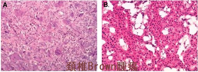 頚椎Brown腫瘍 組織像 頚椎Brown腫瘍 組織像