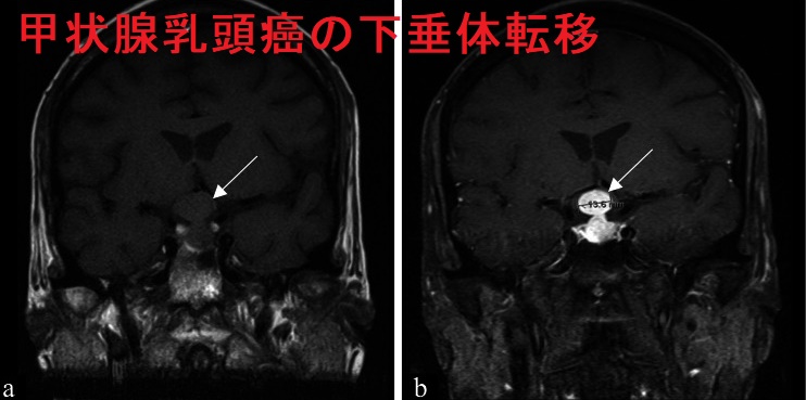 甲状腺乳頭癌の下垂体転移 甲状腺乳頭癌の下垂体転移