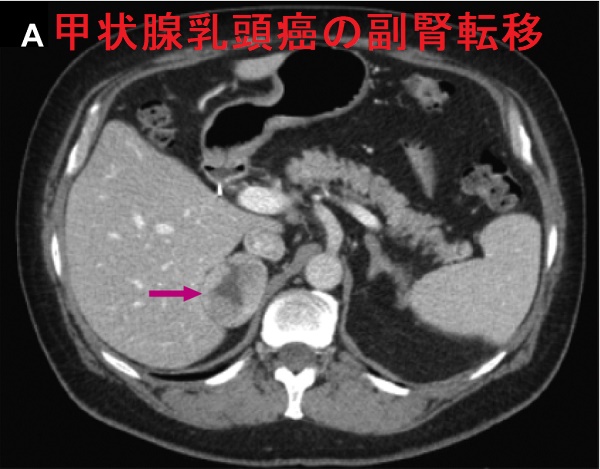 甲状腺乳頭癌の副腎転移 造影CT画像 1 甲状腺乳頭癌の副腎転移 造影CT画像 1