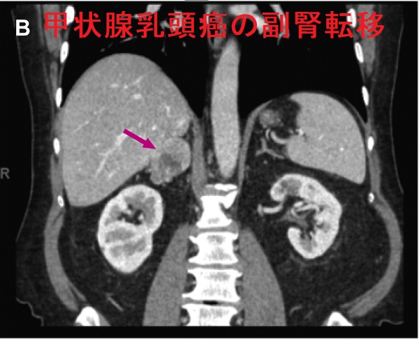 甲状腺乳頭癌の副腎転移 造影CT画像 2 甲状腺乳頭癌の副腎転移 造影CT画像 2