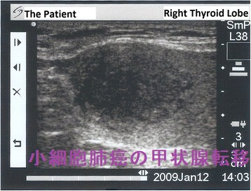 小細胞肺癌の甲状腺転移2 小細胞肺癌の甲状腺転移2