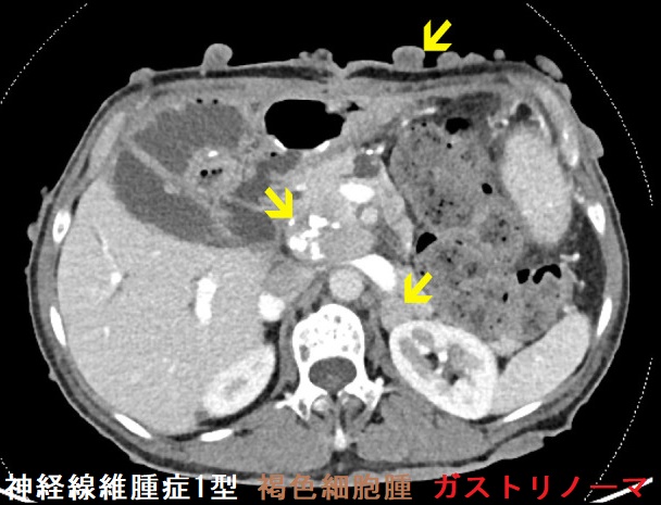 神経線維腫症1型 褐色細胞腫 ガストリノーマ 神経線維腫症1型 褐色細胞腫 ガストリノーマ