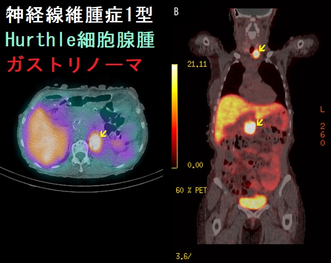 神経線維腫症1型 ハーテル細胞腺腫 ガストリノーマ I-123 MIBG 神経線維腫症1型 ハーテル細胞腺腫 ガストリノーマ I-123 MIBG