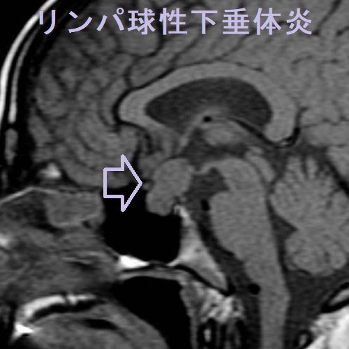 リンパ球性下垂体炎 MRI TI強調画像 リンパ球性下垂体炎 MRI TI強調画像
