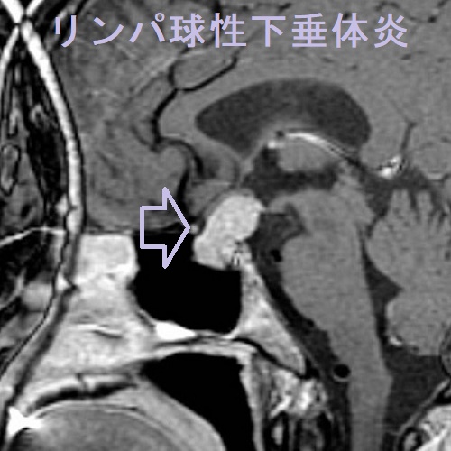 リンパ球性下垂体炎 MRI 造影TI強調画像 リンパ球性下垂体炎 MRI 造影TI強調画像