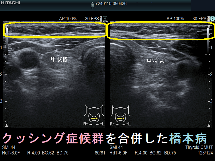 クッシング症候群を合併した橋本病 クッシング症候群を合併した橋本病