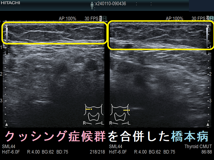 クッシング症候群と甲状腺[橋本病 バセドウ病 甲状腺機能低下症 エコー