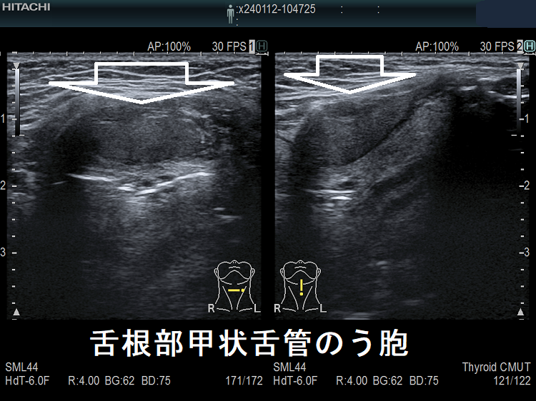 舌根部甲状舌管のう胞 舌根部甲状舌管のう胞