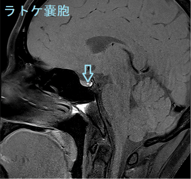 ラトケ嚢胞MRI 画像 ラトケ嚢胞MRI 画像