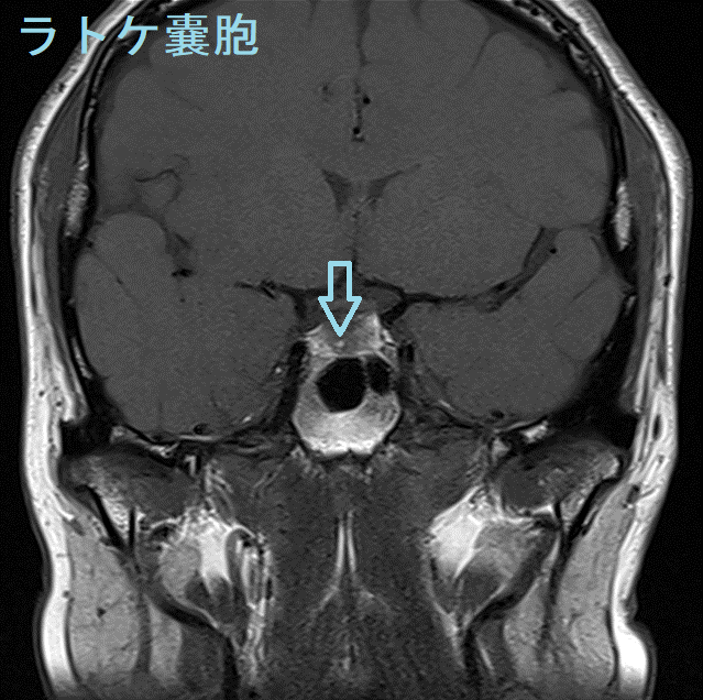 ラトケ嚢胞MRI 画像2 ラトケ嚢胞MRI 画像2