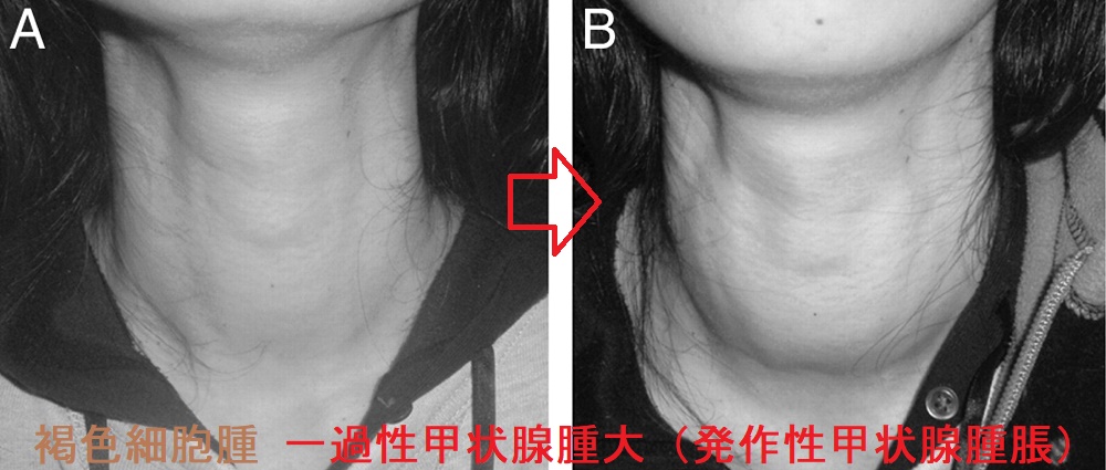 褐色細胞腫 一過性甲状腺腫大(発作性甲状腺腫脹) 褐色細胞腫 一過性甲状腺腫大(発作性甲状腺腫脹)
