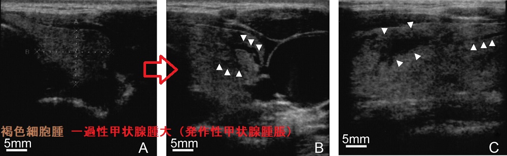 褐色細胞腫 一過性甲状腺腫大(発作性甲状腺腫脹)超音波画像 褐色細胞腫 一過性甲状腺腫大(発作性甲状腺腫脹)超音波画像