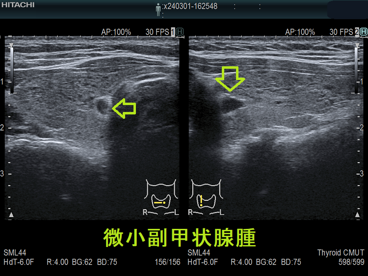 微小副甲状腺腫 微小副甲状腺腫