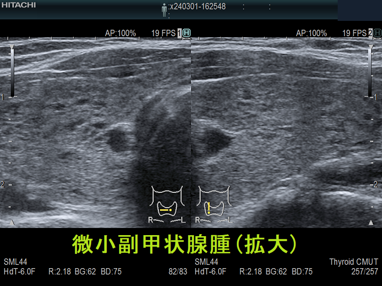 微小副甲状腺腫(拡大) 微小副甲状腺腫(拡大)