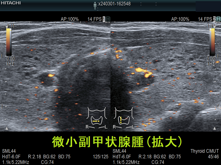 微小副甲状腺腫(拡大) ドプラーモード 微小副甲状腺腫(拡大) ドプラーモード