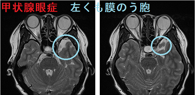 甲状腺眼症 左くも膜のう胞 甲状腺眼症 左くも膜のう胞