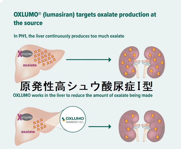 原発性高シュウ酸尿症I型 原発性高シュウ酸尿症I型